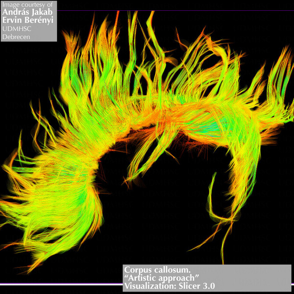 трёхмерная модель мозолистого тела с нейронными отростками, которые входят в него с обоих полушарий